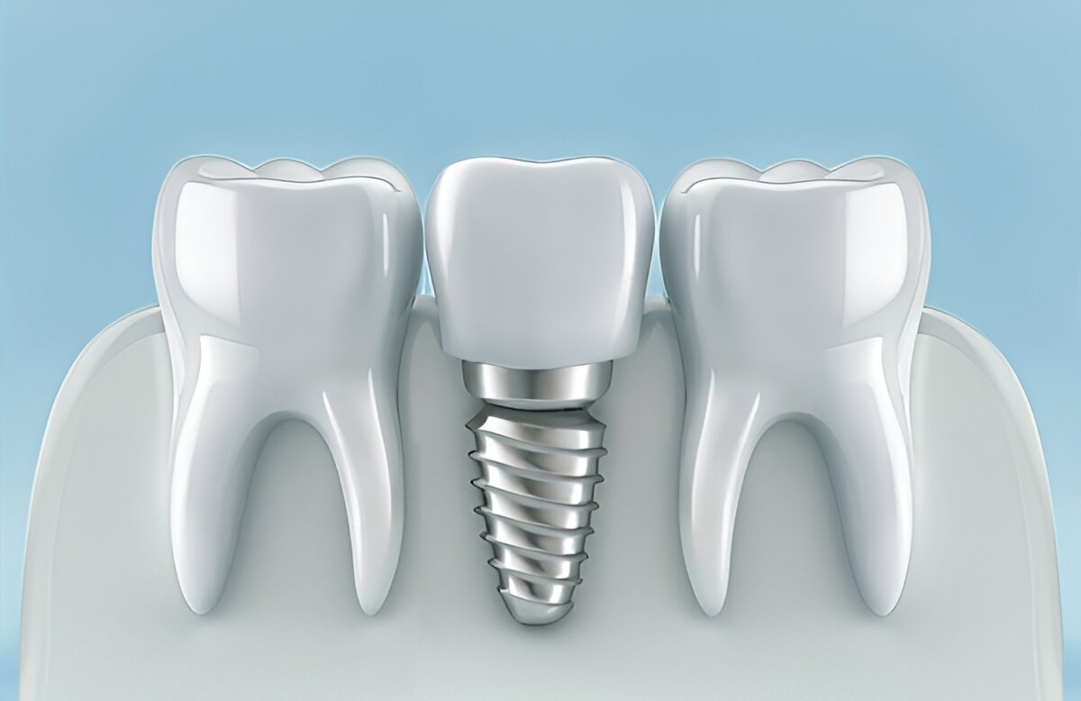 dental implants in beltline, calgary