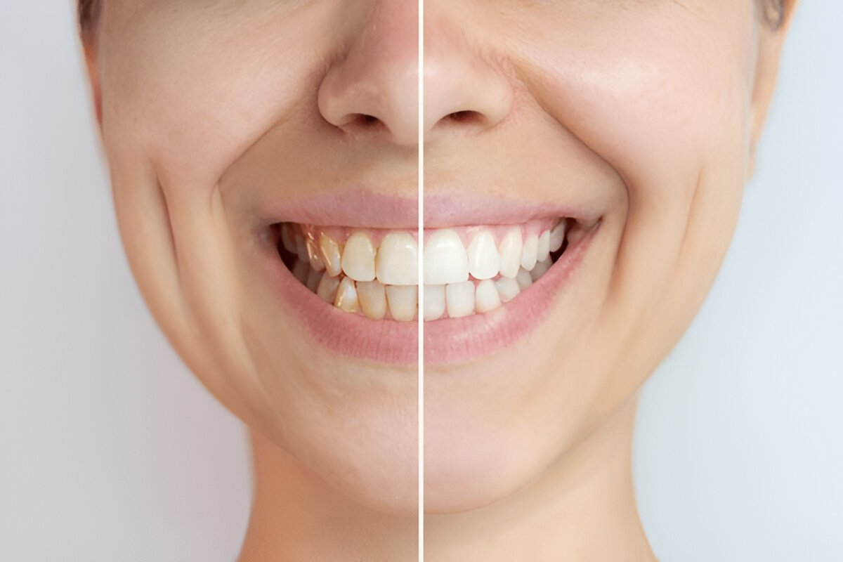 teeth whitening near you