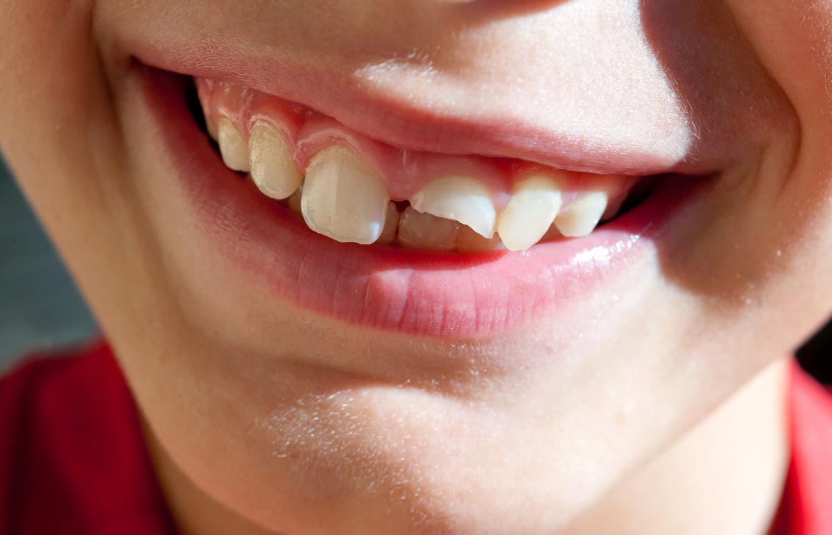 chipped or fractured teeth repair near you