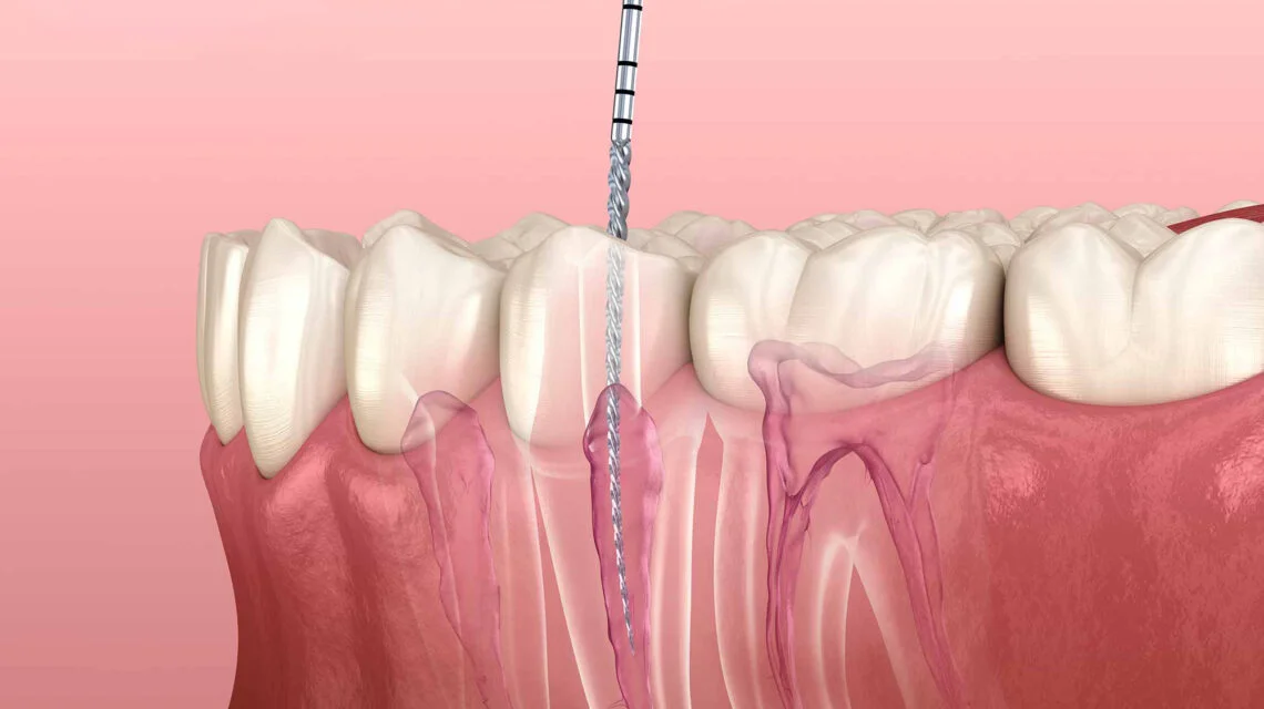 emergency root canal treatment near you