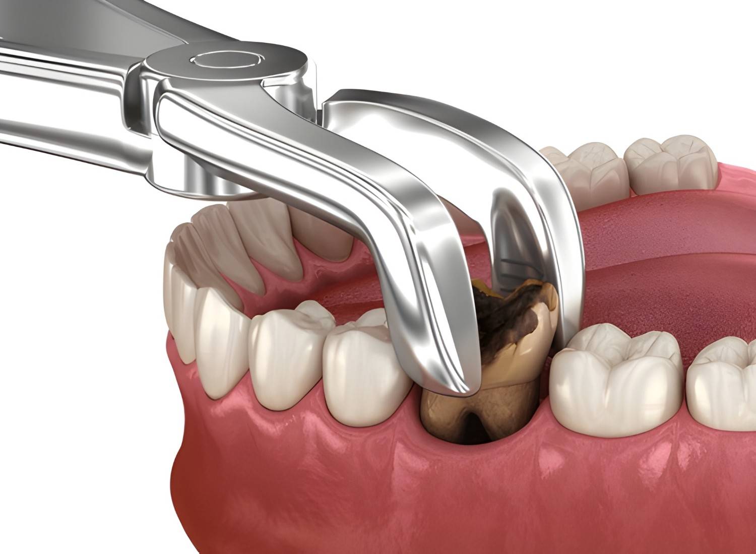 How Long Does It Take to Recover from a Tooth Extraction