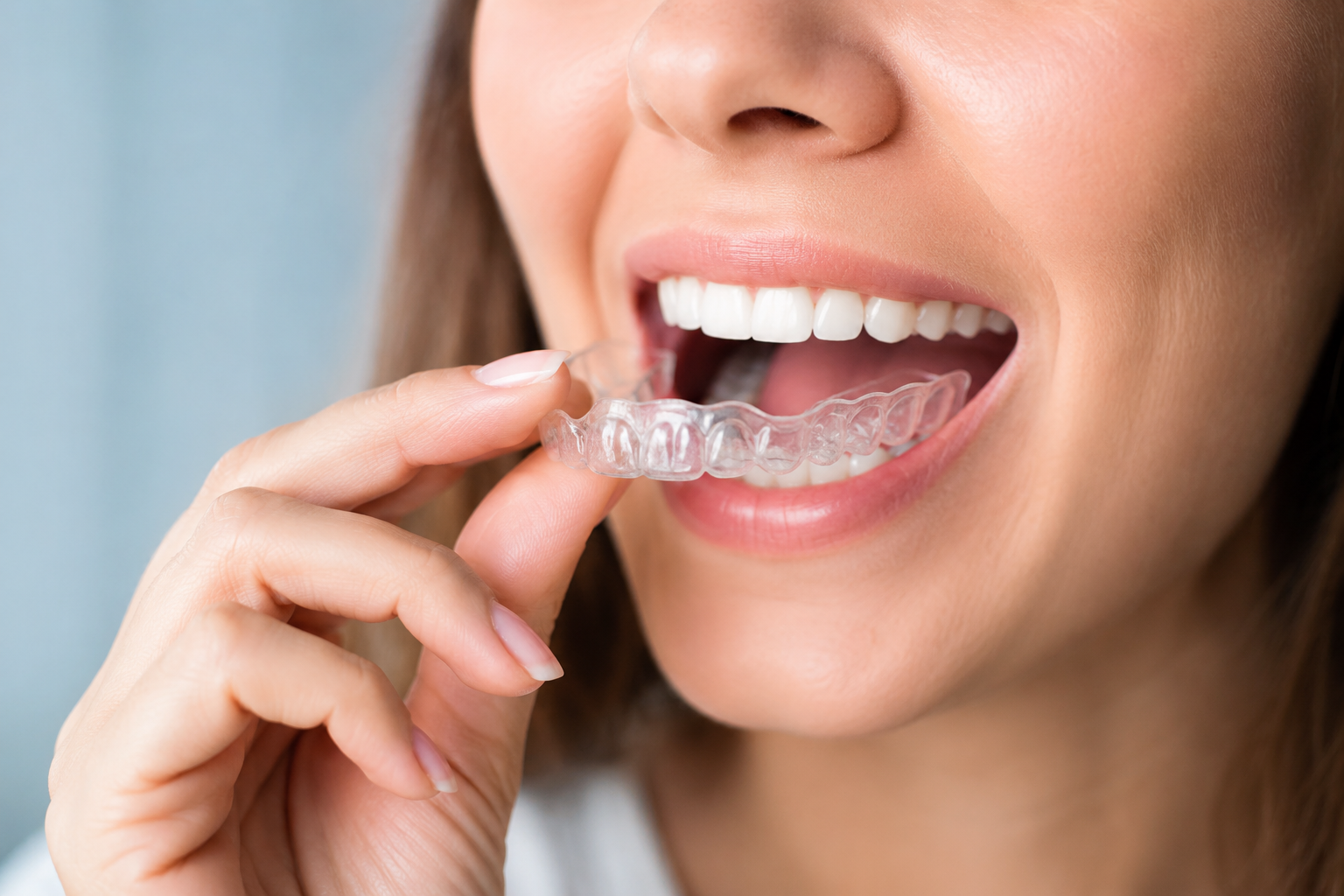 What is invisalign a complete guide to clear aligners